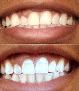 smile brilliant before and after
